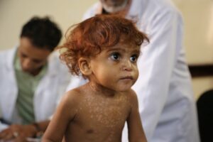 “Yemen’de son yedi yılda 11 bin çocuk öldü veya yaralandı”