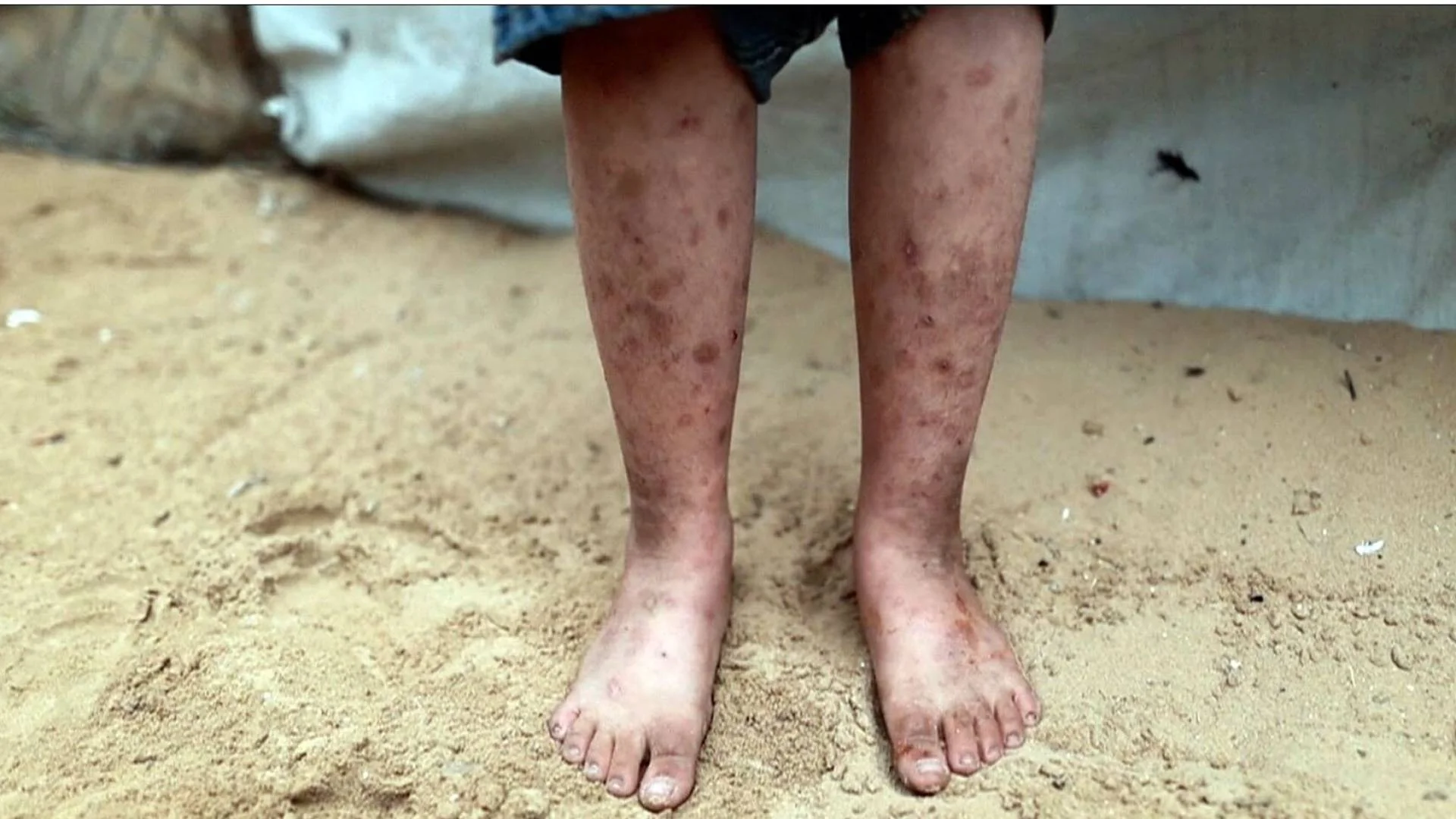 BM uyarısı: Kemirgenler ve cilt hastalıkları Gazze Şeridi’ndeki mülteci çadırlarını istila ediyor